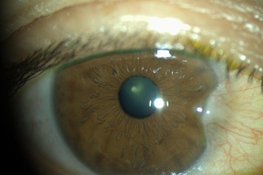 Usamos "cola" nos olhos?